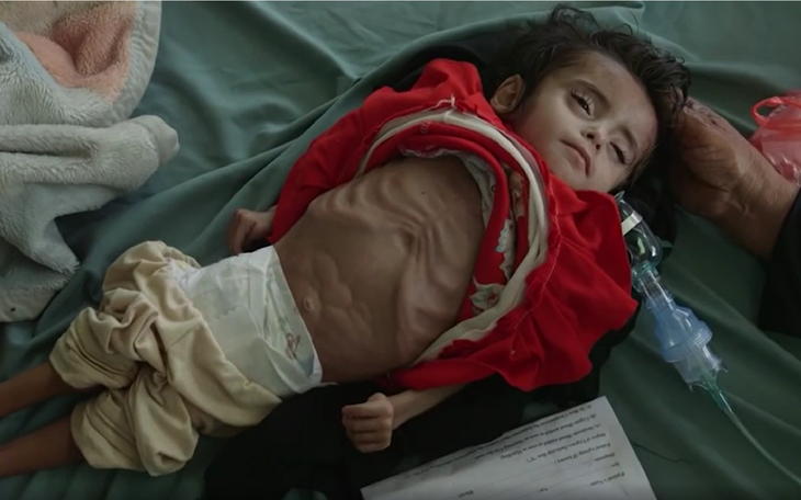 Trẻ em Yemen còn da bọc xương vì nạn đói và nội chiến kéo dài