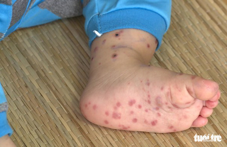 Hai bệnh nhi tử vong vì sốt xuất huyết và tay chân miệng - Ảnh 2.
