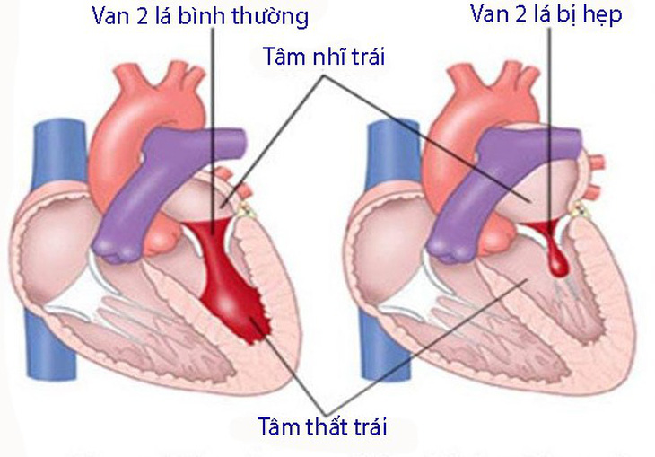 Hẹp van hai lá - Ảnh 1.