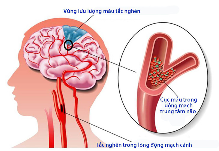 Không nên chủ quan với bệnh tai biến mạch máu não nhẹ - Ảnh 1.