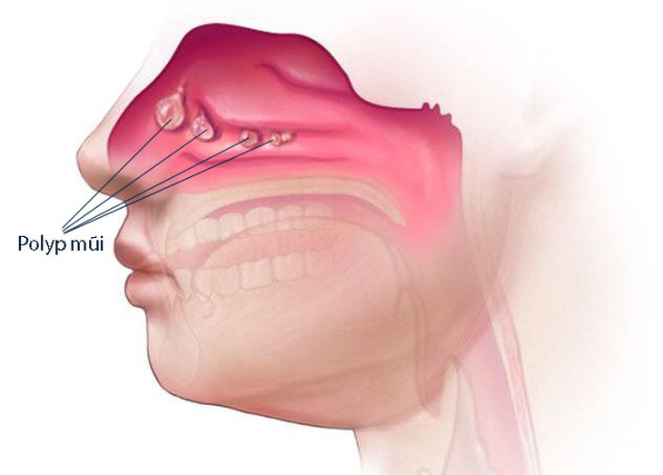 Polyp mũi - Nguyên nhân và cách điều trị - Ảnh 1.