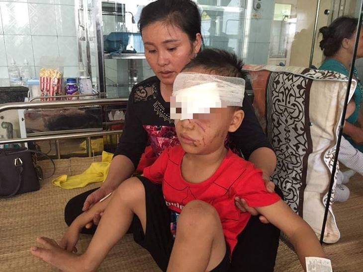 Thanh Hóa: Bé trai 6 tuổi bị chó nhà cắn suýt hư mắt - Ảnh 1.