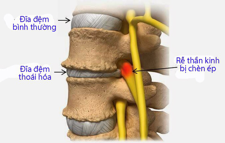 Bệnh đau thắt lưng - Ảnh 1.