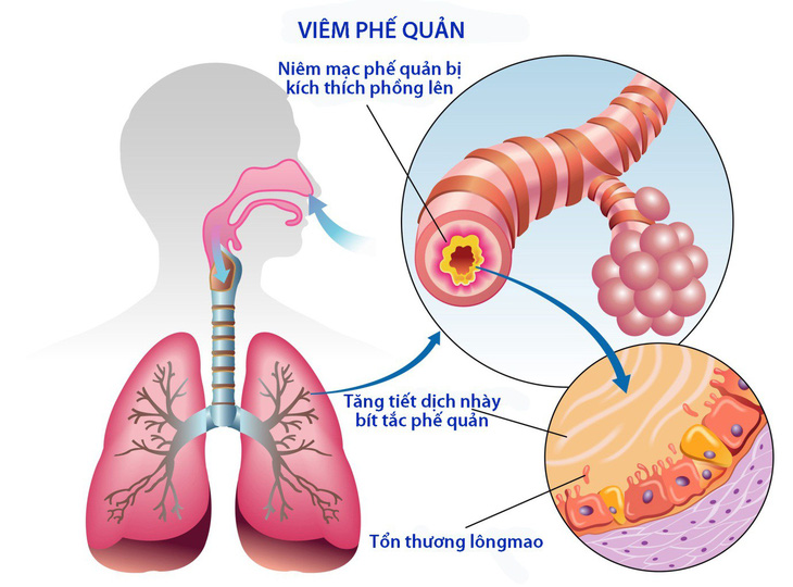 Viêm phế quản cấp ở người lớn - Ảnh 1.