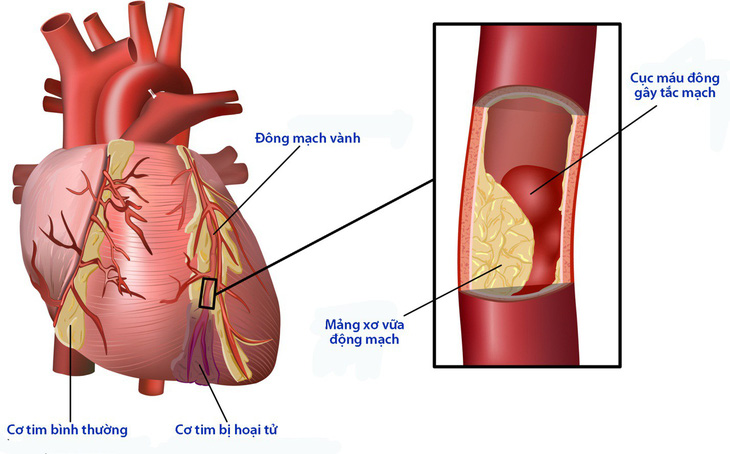Biến chứng tim mạch của bệnh đái tháo đường - Ảnh 1.