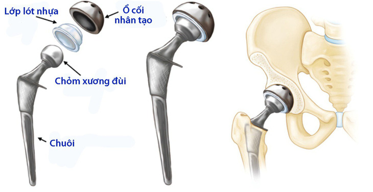 Thay khớp háng toàn phần - Ảnh 1.