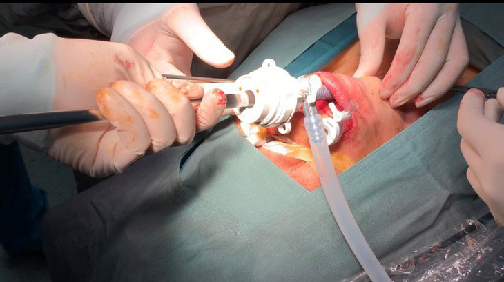 Lần đầu phẫu thuật nội soi cắt tuyến giáp không để lại sẹo - Ảnh 2.