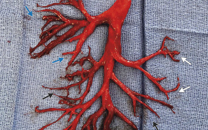 Bệnh nhân Mỹ ho ra cục máu đông có hình cây phế quản