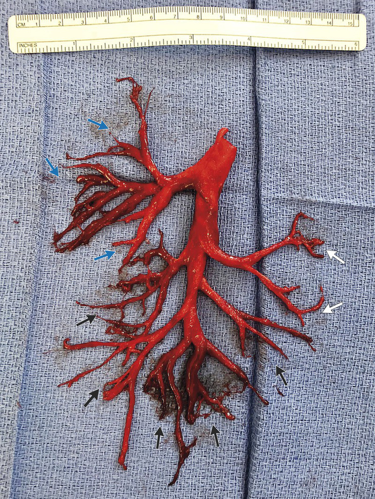 Bệnh nhân Mỹ ho ra cục máu đông có hình cây phế quản - Ảnh 1.