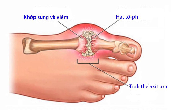 Chẩn đoán và điều trị bệnh gout - Ảnh 1.