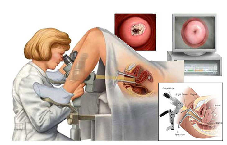 Phát hiện sớm ung thư cổ tử cung bằng phương pháp soi cổ tử cung - Ảnh 1.