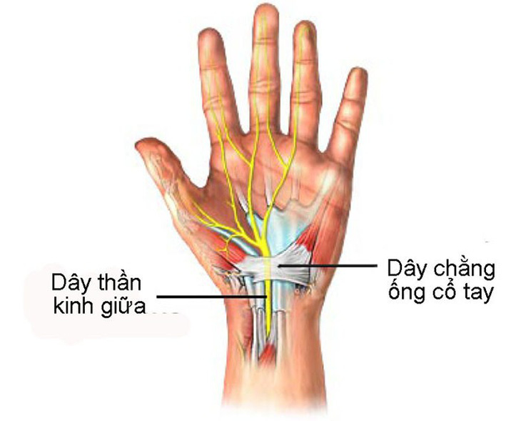 Hội chứng ống cổ tay - Ảnh 1.