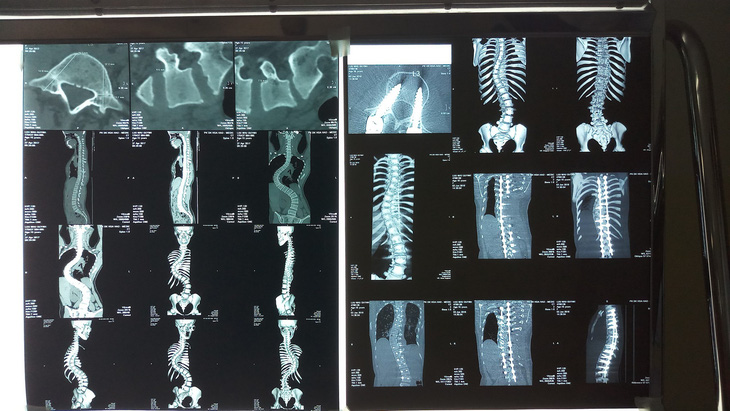 Thiếu nữ 15 tuổi có cột sống cong vẹo như chữ S - Ảnh 1.