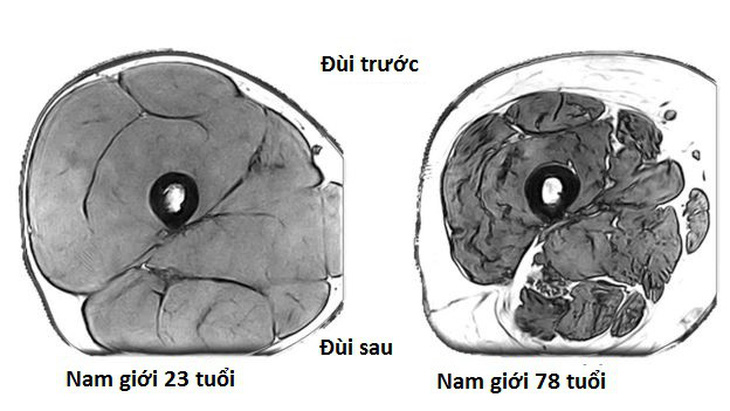 Mất cơ ở người già có thể do suy giảm lượng dây thần kinh - Ảnh 3.