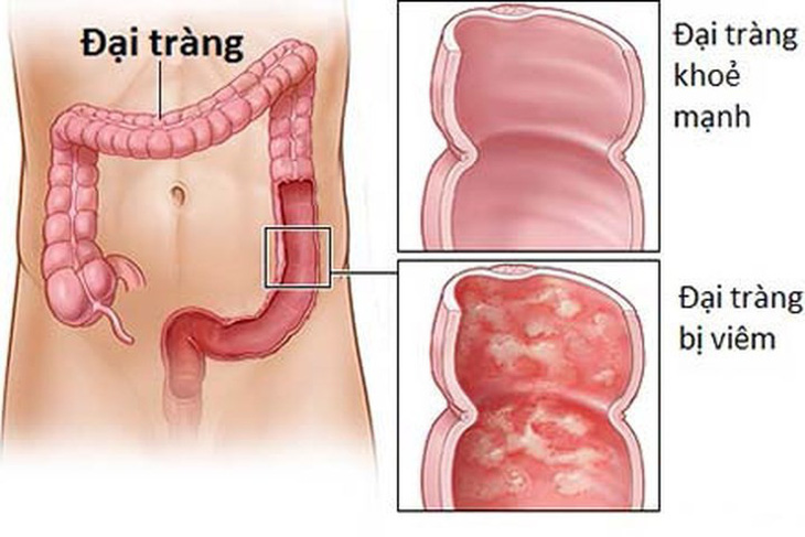 Những điều cần biết về viêm loét đại tràng - Ảnh 1.