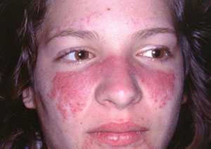 Lupus ban đỏ, căn bệnh nguy hiểm ít được biết đến - Ảnh 1.