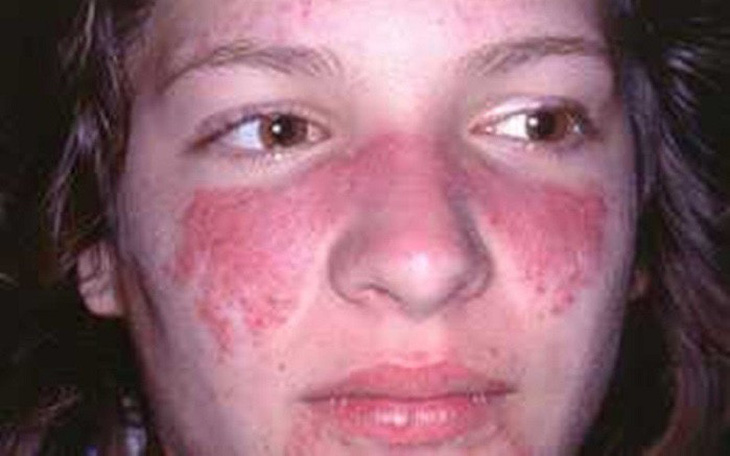 Lupus ban đỏ, căn bệnh nguy hiểm ít được biết đến