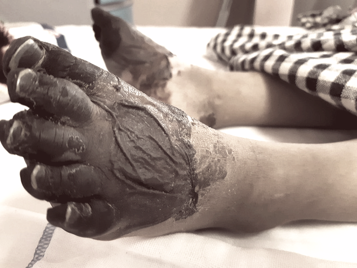 Bé gái 3 tuổi phải cắt cụt hai tay sau nhiễm khuẩn huyết - Ảnh 2.