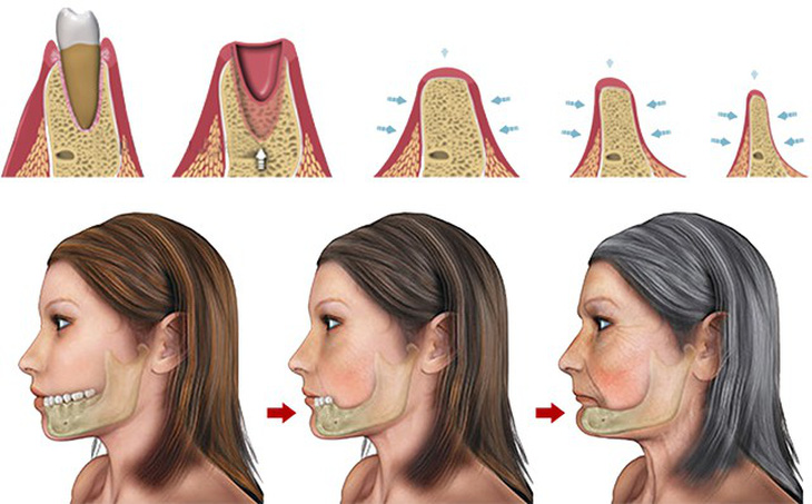 Nha khoa cấy ghép Implant cho người bị mất răng lâu năm - Ảnh 2.