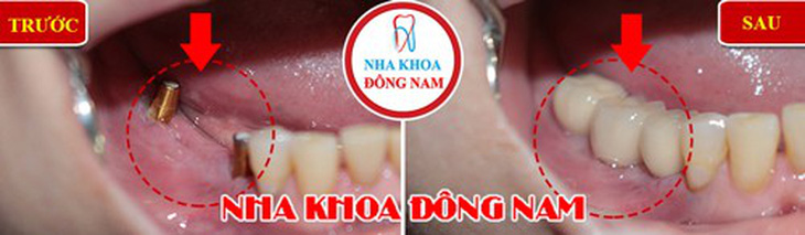 Nha khoa cấy ghép Implant cho người bị mất răng lâu năm - Ảnh 3.