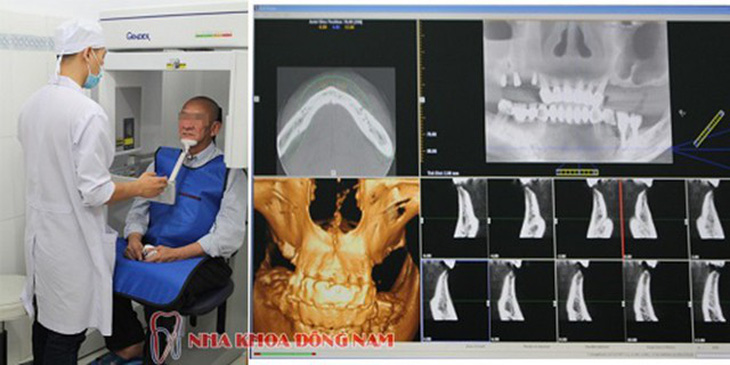 Nha khoa cấy ghép Implant cho người bị mất răng lâu năm - Ảnh 4.