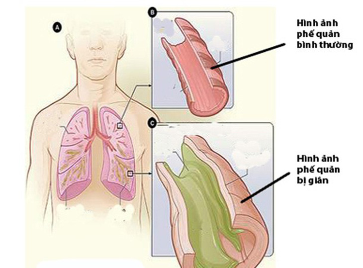 Bệnh giãn phế quản - Ảnh 1.