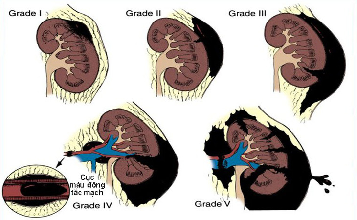 Chấn thương thận - Ảnh 1.