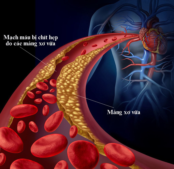 Cách ngăn ngừa rối loạn lipid máu - Ảnh 1.