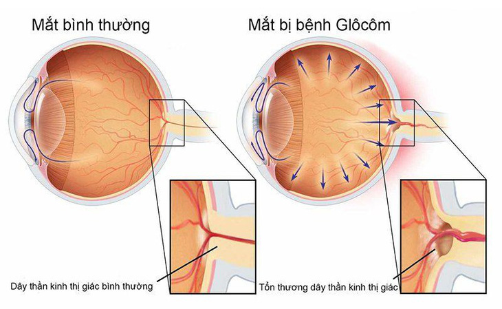 Bệnh glôcôm: Những triệu chứng thường dễ bị bỏ qua - Ảnh 1.