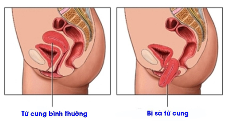 Vài điều cần biết về sa sinh dục - Ảnh 1.