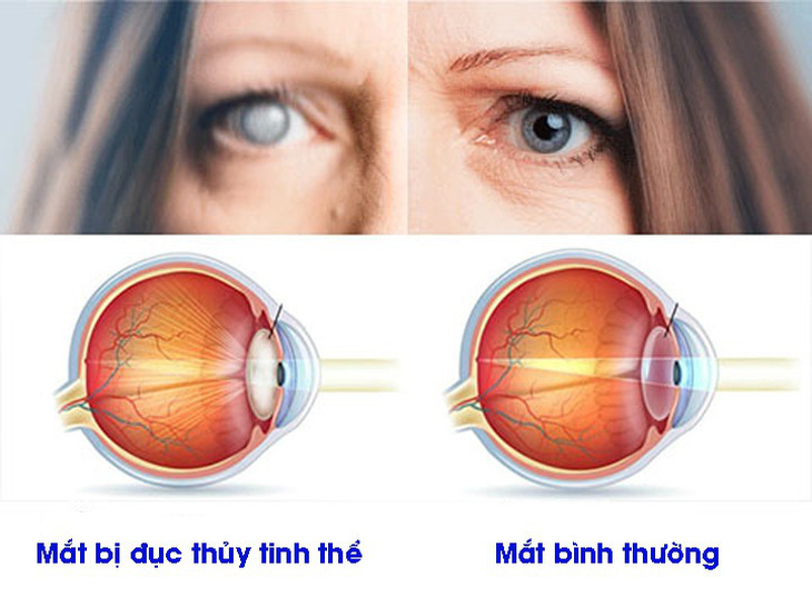 5 bệnh về mắt thường gặp ở người già - Ảnh 1.