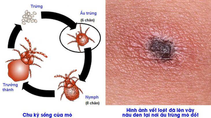 Bệnh sốt mò - phát hiện muộn dễ gây tử vong