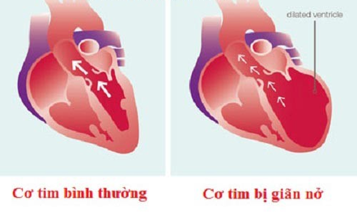 Căn bệnh nào được xem là ung thư của tim? - Ảnh 1.