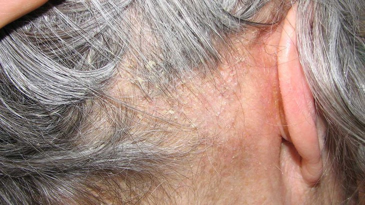 Những điều cần biết về viêm da tiết bã - Ảnh 1.