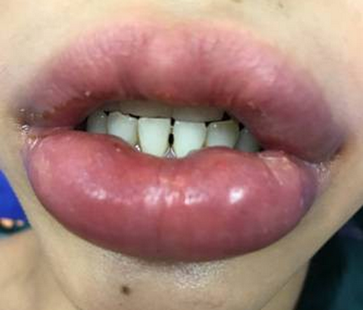 Lại một phụ nữ gặp tai biến vì bơm môi ở thẩm mỹ viện - Ảnh 1.