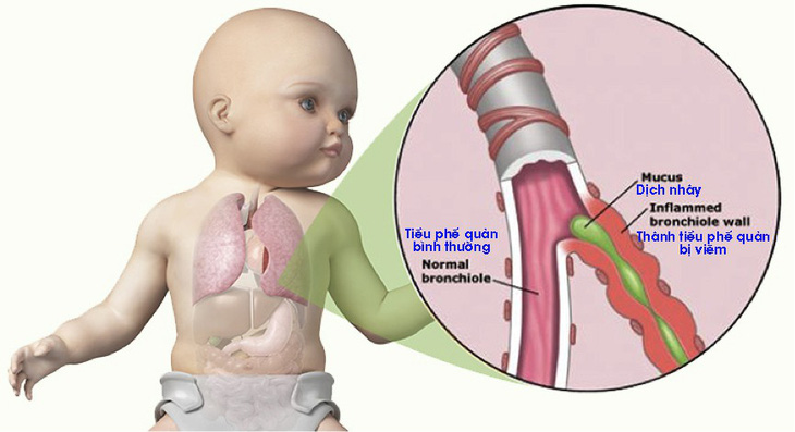 Bệnh viêm tiểu phế quản - Ảnh 1.