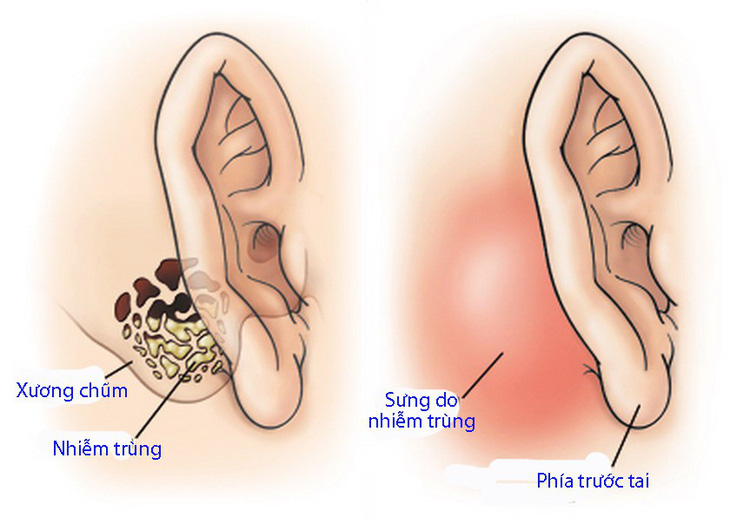 Viêm xương chũm - Ảnh 1.