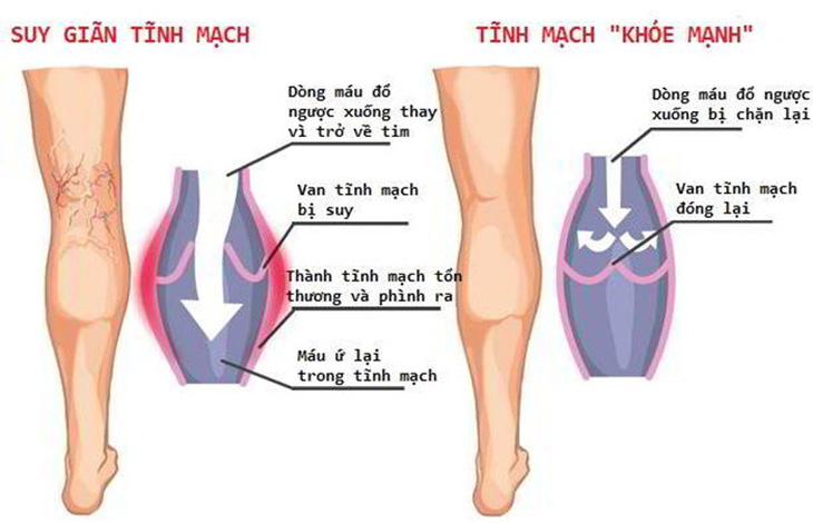 Giãn tĩnh mạch chân - Ảnh 1.