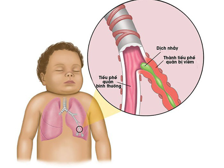 Bệnh viêm tiểu phế quản ở trẻ - Ảnh 1.