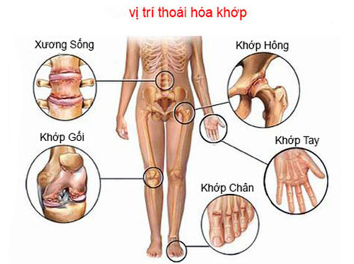 Thoái hóa khớp ở người cao tuổi - Ảnh 1.