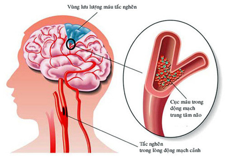 Dấu hiệu và cách xử trí cơn thiếu máu não thoáng qua - Ảnh 1.