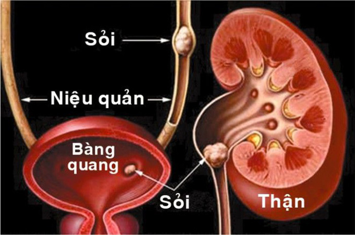 Phòng tránh bệnh sỏi tiết niệu - Ảnh 1.