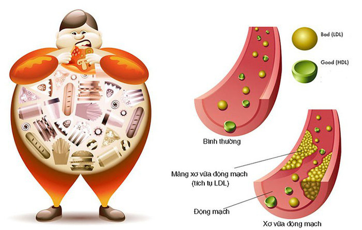 Tác hại do tăng mỡ máu và cách kiểm soát - Ảnh 1.