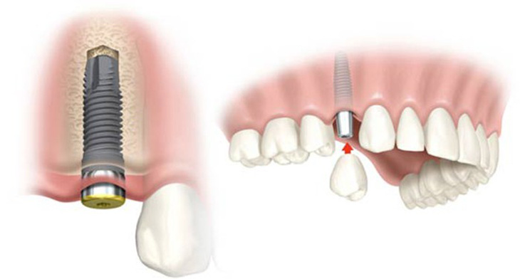 Ưu điểm răng Implant ETK Active của Nha Khoa Đông Nam - Ảnh 1.