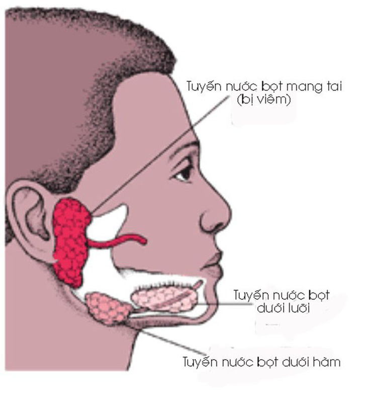 Bệnh quai bị và cách phòng ngừa - Ảnh 1.