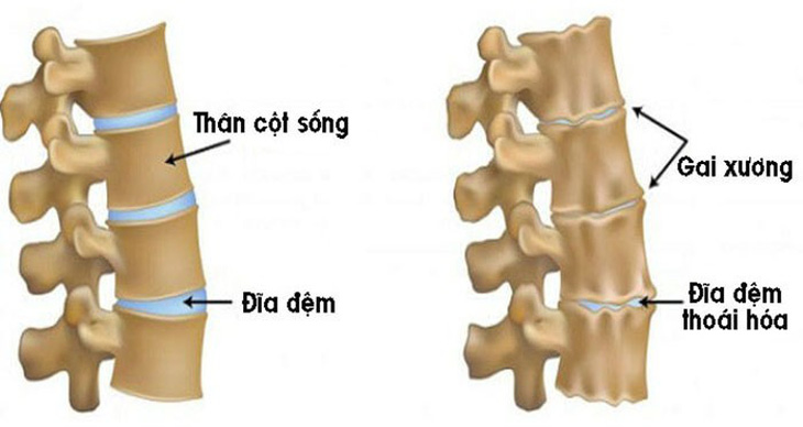 Chữa gai cột sống, vôi hóa cột sống - Ảnh 1.