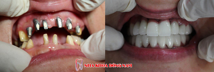 Ưu điểm răng Implant ETK Active của Nha Khoa Đông Nam - Ảnh 5.