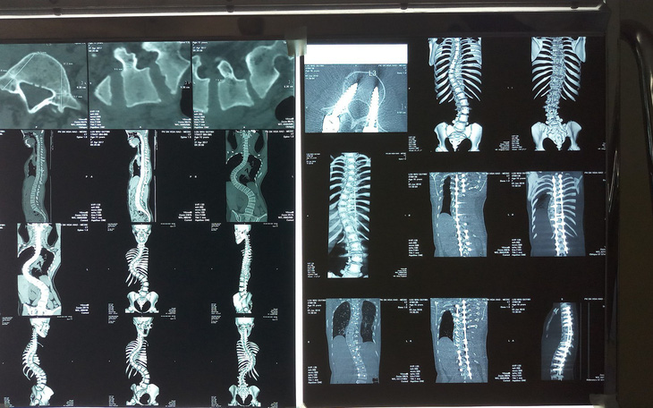 Thiếu nữ 15 tuổi có cột sống cong vẹo như chữ S