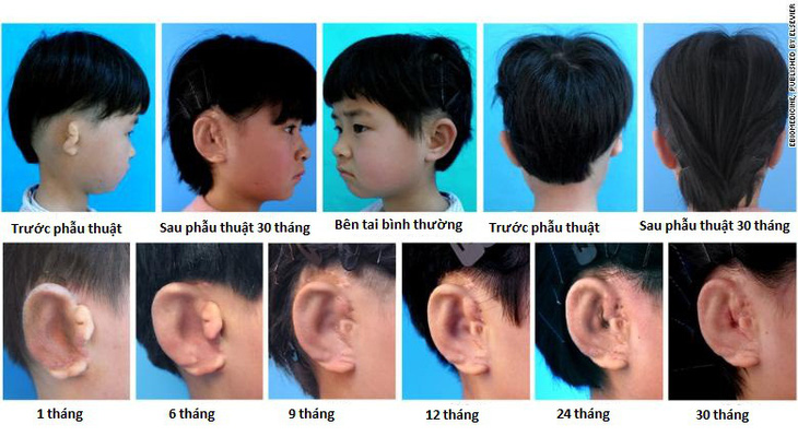 Trung Quốc nuôi và cấy ghép thành công tai từ tế bào sụn - Ảnh 1.