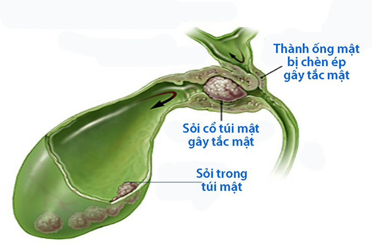 Bệnh sỏi mật - Ảnh 1.